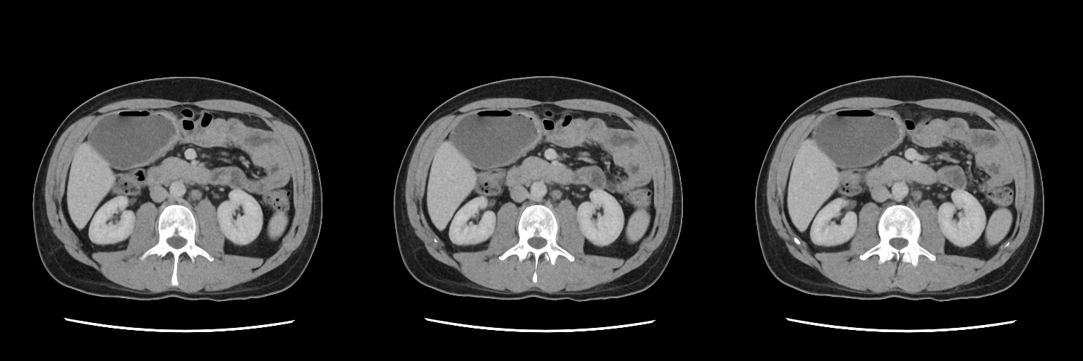 CTScan Slices